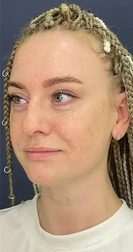 После - Биоревитализация