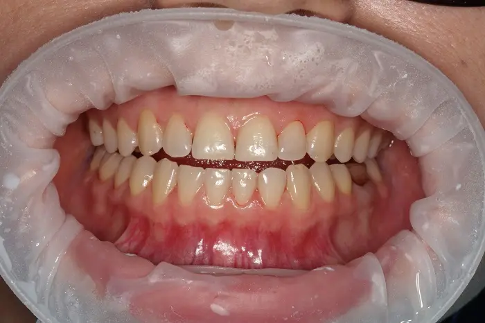 До - Отбеливание ZOOM-4