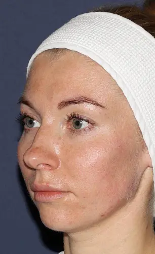 После - Контурная пластика