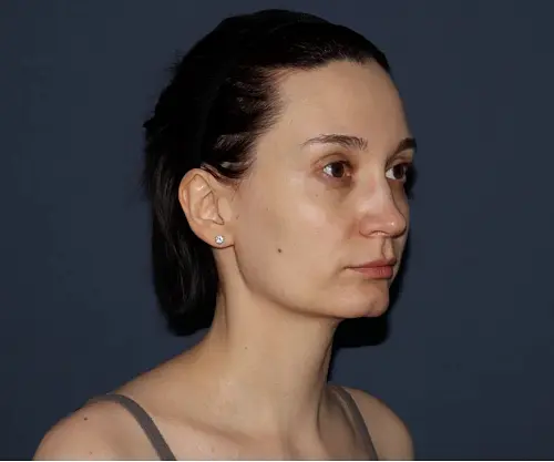 После - Ботулинотерапия