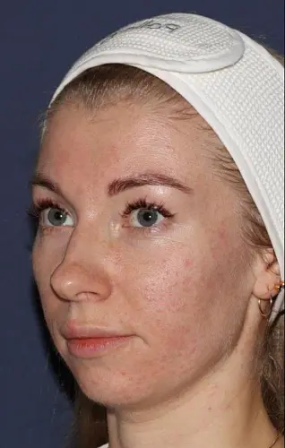 До - Контурная пластика