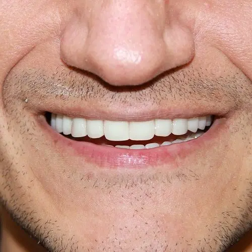 После - Имплантация All-on-4