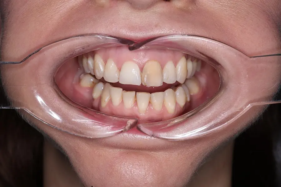 До - Установка виниров E-max